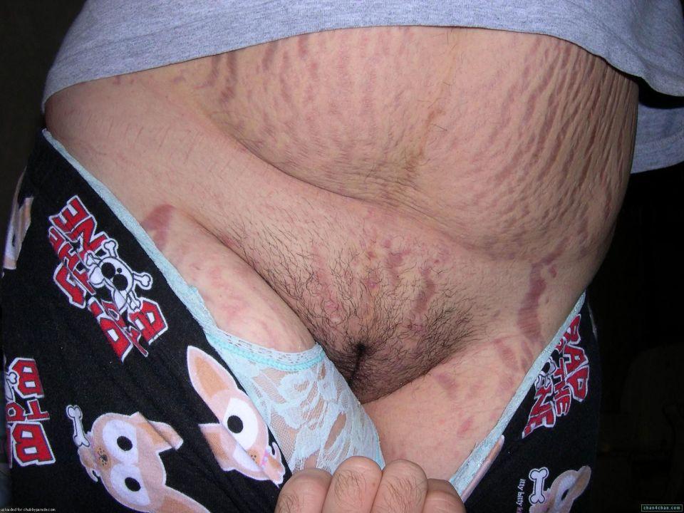 Stretch mark fetish